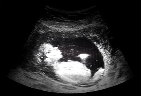 Entwicklung des Embryos Sonogram Bild eines Babies